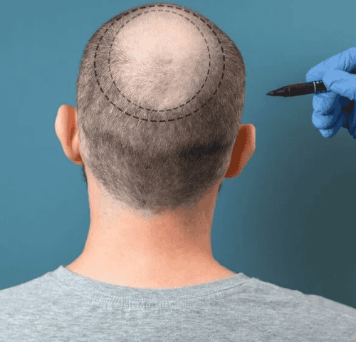 The Best Hair Transplant In Turkey