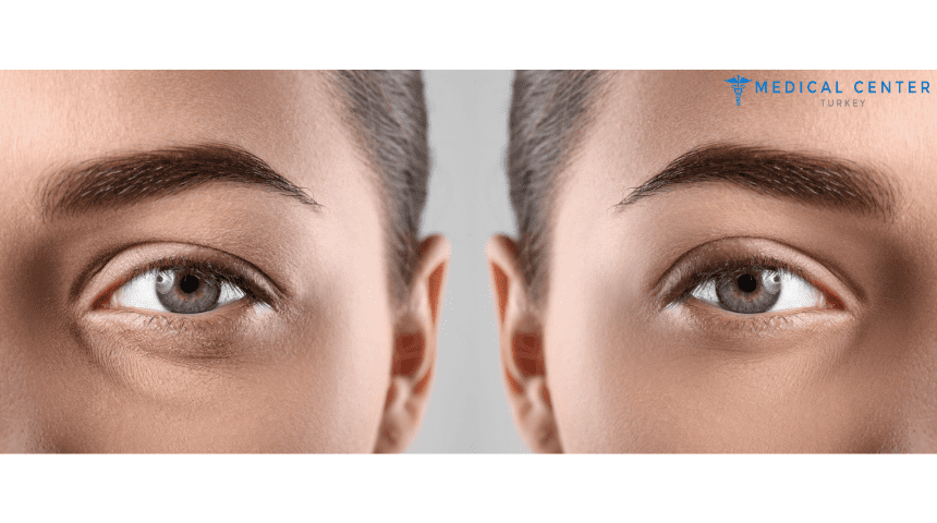 Blepharoplasty_In_Turkey
