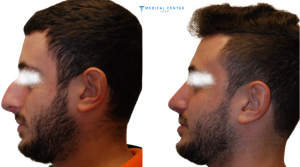 Male Rhinoplasty in Turkey 3