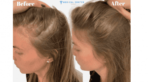 How Long Is the Hair Transplant Recovery Time?