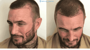 David Beckham's Hair Transplantation