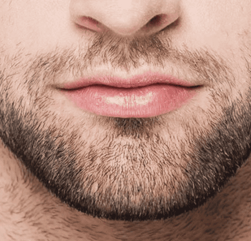 Beard Transplant In Turkey