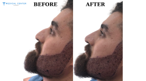 Beard Transplant Cost Turkey 