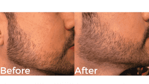 Beard Transplant In Turkey