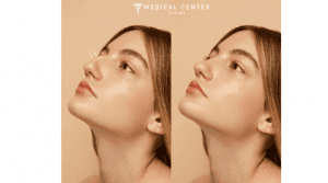 Rhinoplasty Septoplasty and a Deviated Septum