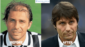 Antonio Conte's Hair Transplantation