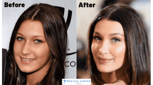 Bella Hadid's Rhinoplasty Surgery