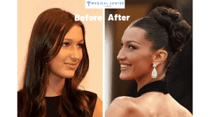Bella Hadid's Rhinoplasty Surgery