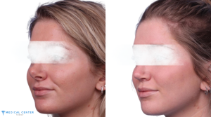 Rhinoplasty Surgery