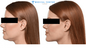 Mentoplasty İn Turkey