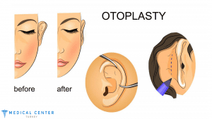 Ear Correction Cost in Turkey