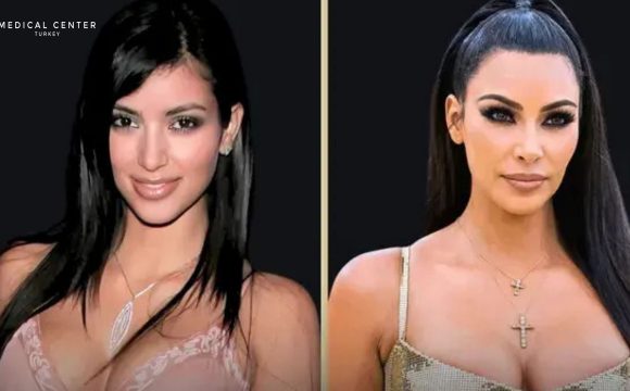 Kim Kardashian's Rhinoplasty Surgery