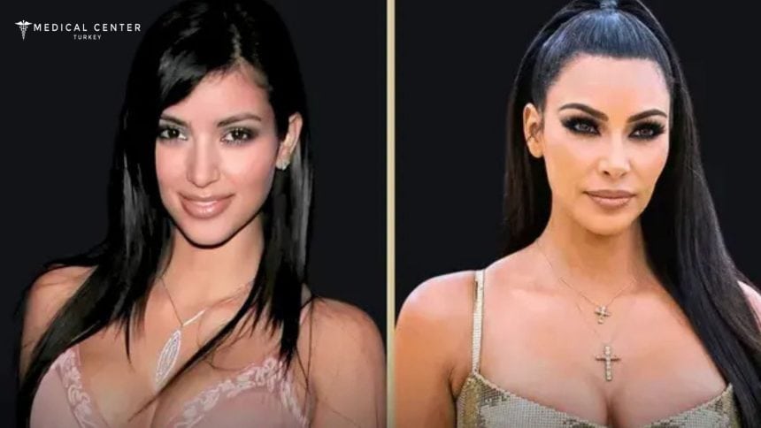 Kim Kardashian's Rhinoplasty Surgery