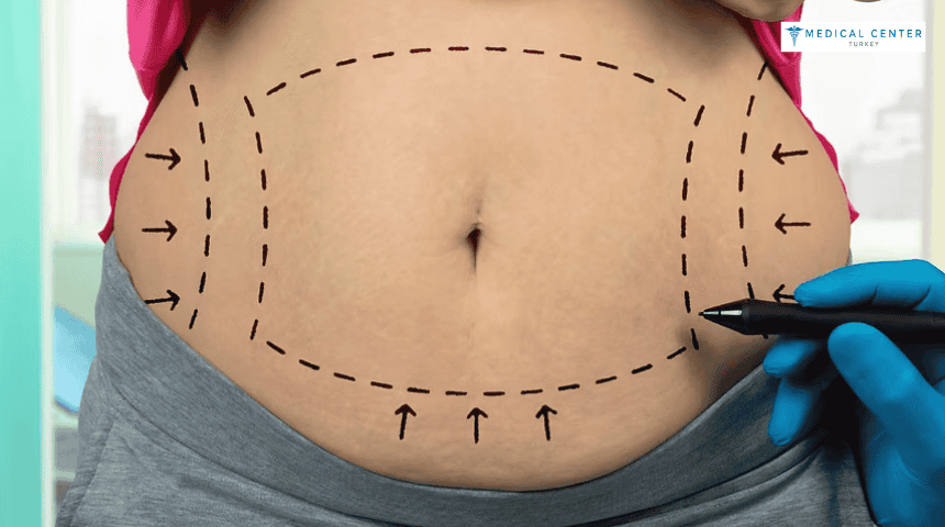 Fat Removal in Turkey