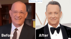 Tom Hanks’ Hair Transplantation