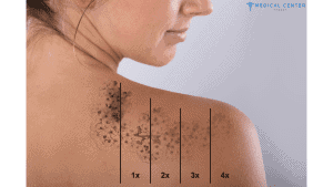 Tattoo Removal In Turkey Cost
