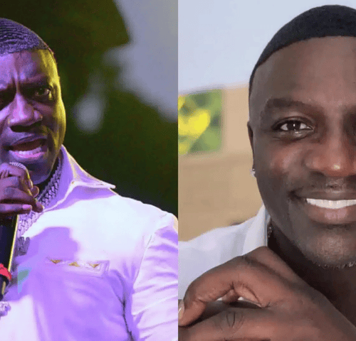 Akon's Hair Transplantation