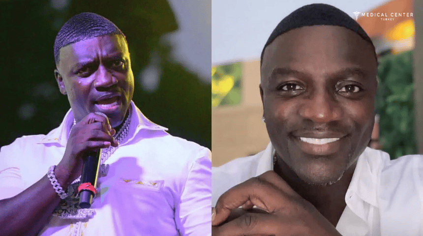 Akon's Hair Transplantation Akon's Hair Transplantation
