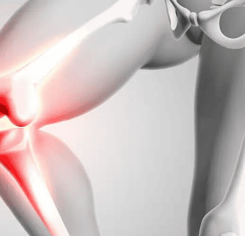 Knee Replacement Surgery in Turkey Knee Replacement Surgery in Turkey