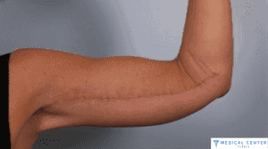 Arm Lift in Turkey