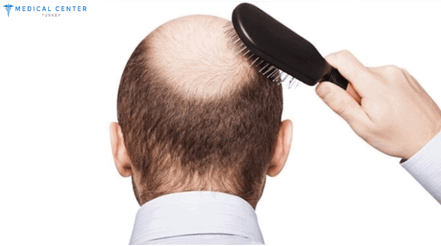 Shock Loss After Hair Transplant