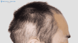 Shock Loss After Hair Transplant