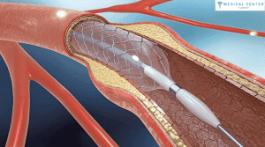 Open Heart Surgery in Turkey