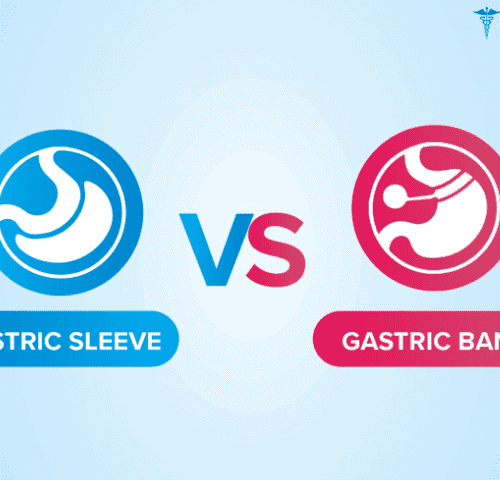 Gastric Band vs Gastric Sleeve