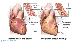 Heart Bypass Surgery in Turkey