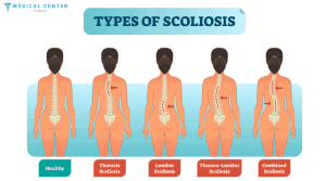 Spinal Fusion Cost in Turkey