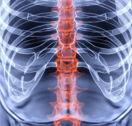 Spinal Fusion Cost in Turkey Spinal Fusion Cost in Turkey