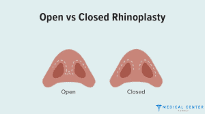 Cheapest Countries For Nose Job