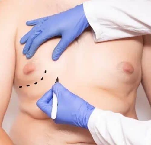Gynecomastia Surgery in Turkey