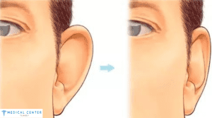 Otoplasty in Turkey