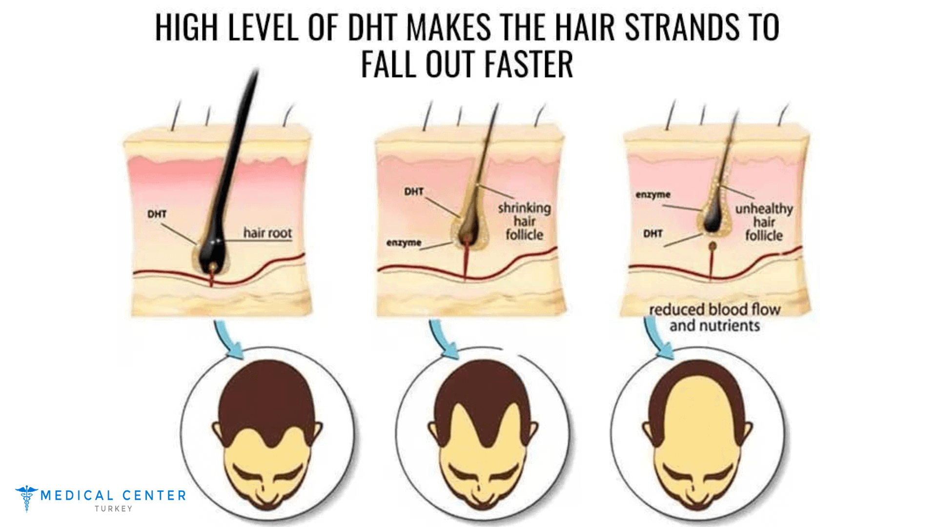 Everything You Need to Know About DHT Blockers