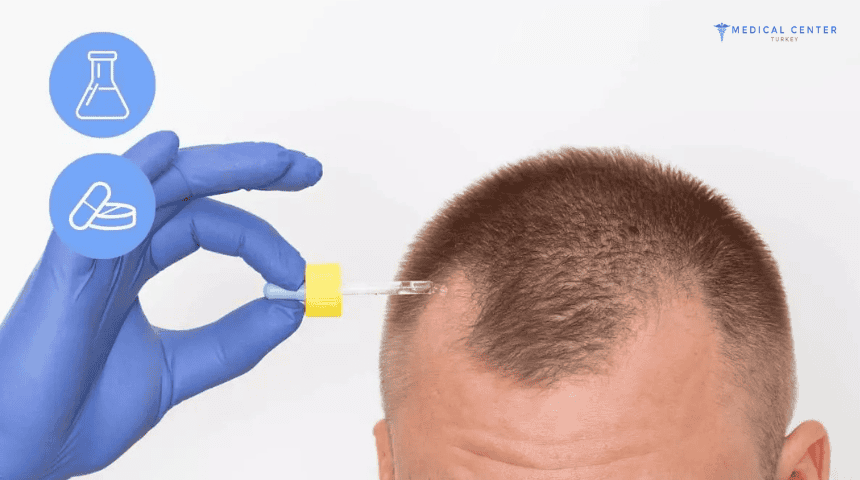 Finasteride vs Minoxidil
