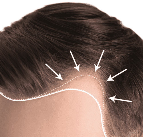 Does Finasteride Regrow Hair?