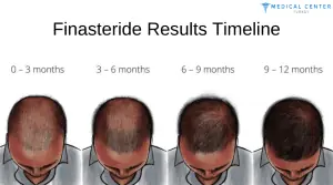 Finasteride vs Minoxidil