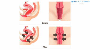 Vaginoplasty vs Labiaplasty