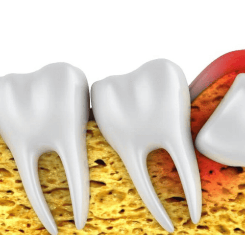 Wisdom Teeth Extraction Turkey