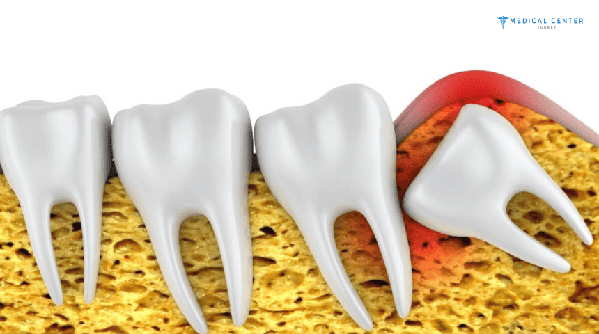 Wisdom Teeth Extraction Turkey