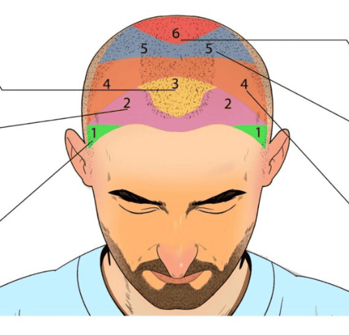 How Much Is Hair Transplant In Turkey?