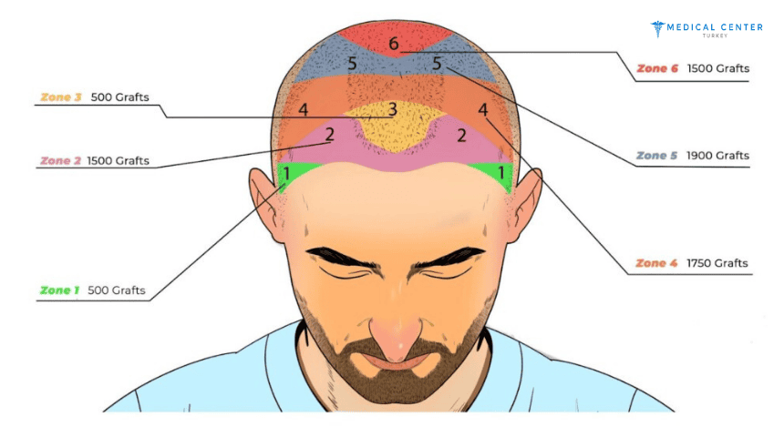 How Much Is Hair Transplant In Turkey? How Much Is Hair Transplant In Turkey?