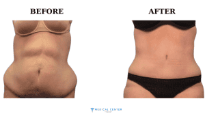 Best Countries for Liposuction 1