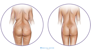 Best Countries for Liposuction 2