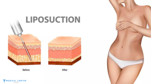 Best Countries for Liposuction 3