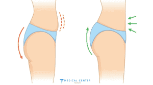 Cheap Mommy Makeover