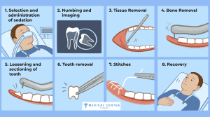 Wisdom Teeth Extraction Turkey