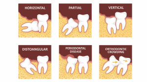 Wisdom Teeth Extraction Turkey