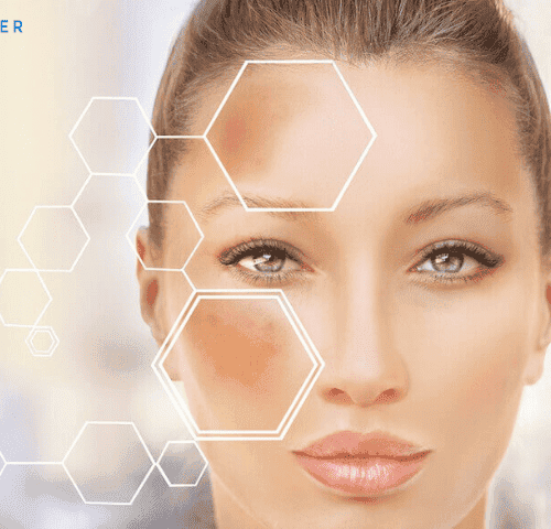 Hyperpigmentation Treatment in Turkey Hyperpigmentation Treatment in Turkey